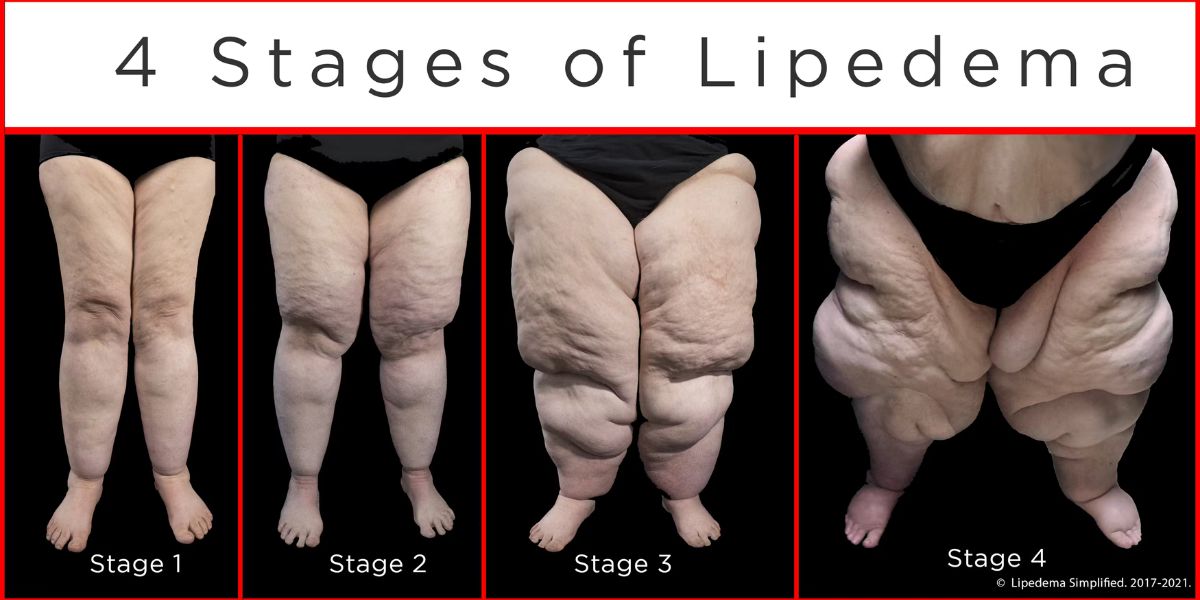 estadios del lipedema
