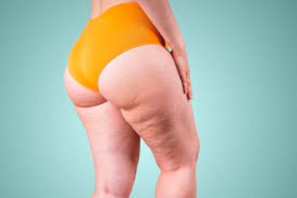 lipedema