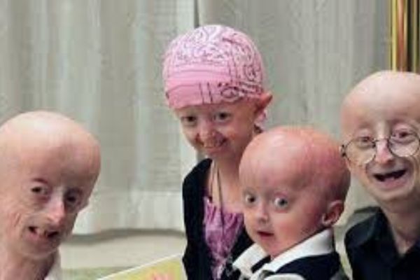 progeria